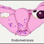 endometrisis
